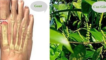 Cao gắm: Phương pháp Đông y trong điều trị gout