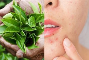 5 cách trị thâm mụn hiệu quả từ lá chè xanh