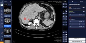 VinBrain cùng bệnh viện ĐH Y dược TP Hồ Chí Minh phát hiện và chẩn đoán ung thư gan bằng AI