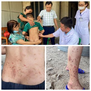 Hà Tĩnh: Hàng trăm người dân bị viêm da dị ứng sau khi bị côn trùng lạ đốt