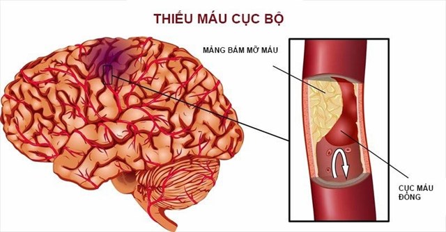 Hiện tượng thiếu m&aacute;u cục bộ. Ảnh minh họa (nguồn internet)