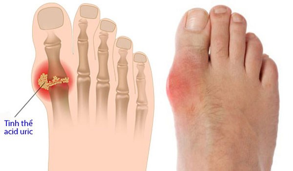 Bệnh gout l&agrave;m sưng đau khớp ng&oacute;n ch&acirc;n c&aacute;i