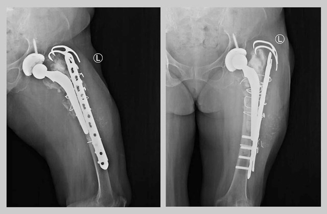 Bệnh viện Trung ương Huế: Đột ph&#225; với ca phẫu thuật Megaprosthesis đầu ti&#234;n tại miền Trung - Ảnh 1
