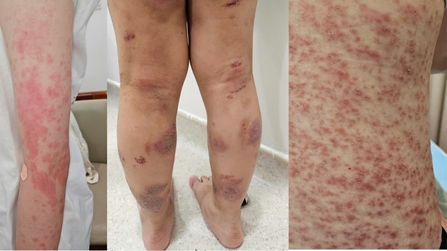 Trường hợp c&aacute;c bệnh li&ecirc;n quan đến dị ứng đến thăm kh&aacute;m tại Vinmec &nbsp;