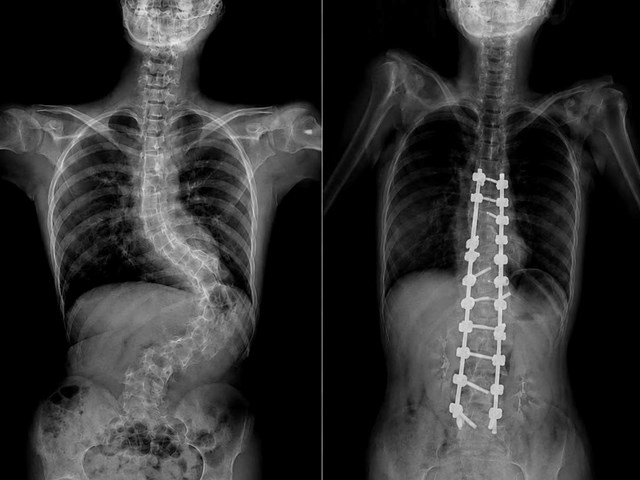 H&igrave;nh ảnh cột sống của b&eacute; A. trước v&agrave; sau khi thực hiện phẫu thuật