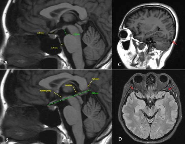 MRI sọ n&atilde;o lần 3 ghi nhận nhiều dấu hiệu gợi &yacute; hội chứng giảm &aacute;p lực nội sọ do r&ograve; dịch n&atilde;o tủy, bao gồm: n&atilde;o sa thấp nhẹ, c&aacute;c khoang dịch quanh n&atilde;o thu hẹp, gi&atilde;n c&aacute;c xoang tĩnh mạch nội sọ v&agrave; d&agrave;y nhẹ m&agrave;ng n&atilde;o.