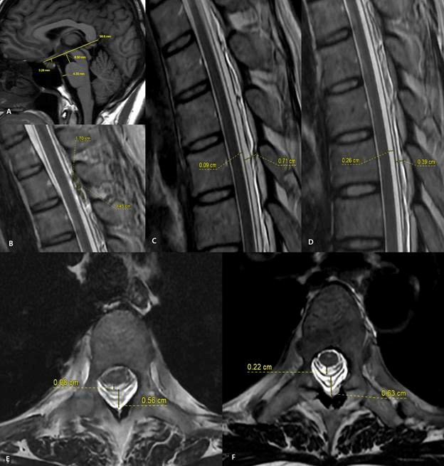 H&igrave;nh ảnh MRI trước v&agrave; sau thủ thuật v&aacute; m&aacute;u ngo&agrave;i m&agrave;ng cứng (EBP).